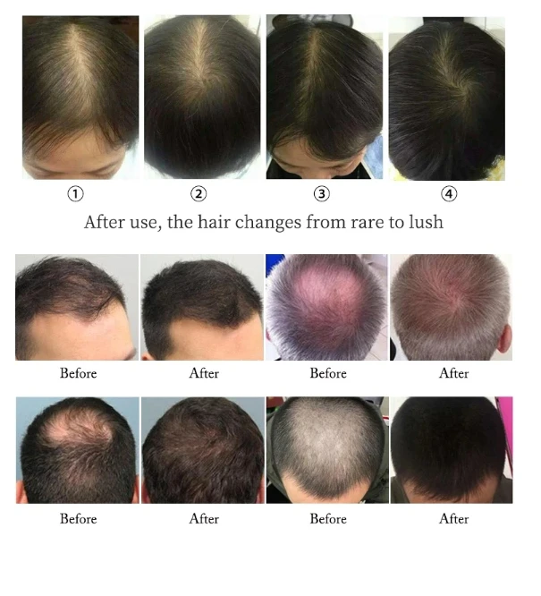hair growth light cap1
