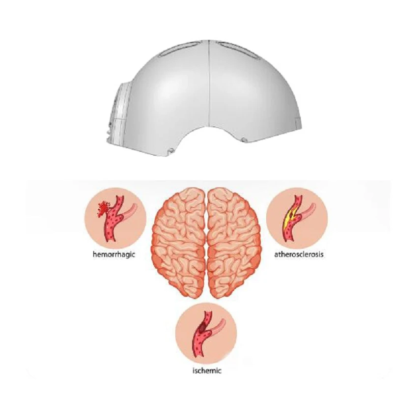 Terapia de luz roja para el Alzheimer