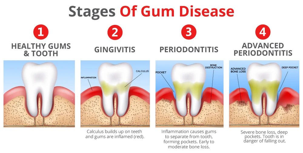 Dental laser treatment for the elderly Dental laser treatment for the elderly