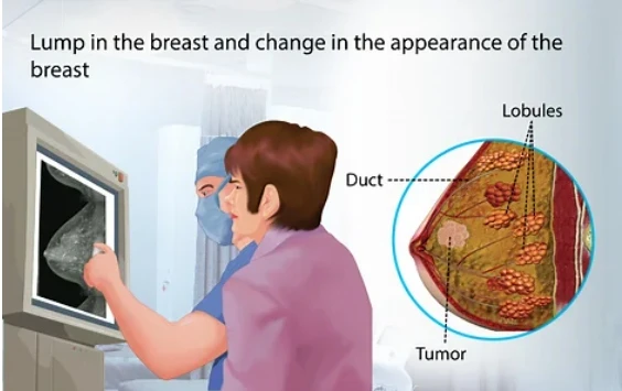 breast screening private1