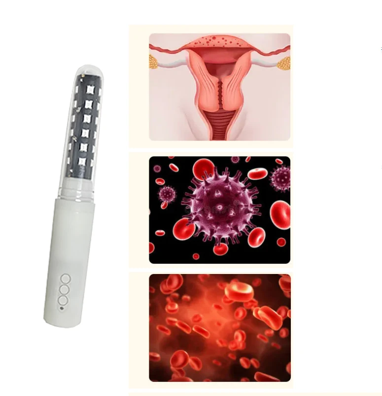 female laser treatment for pelvic floor