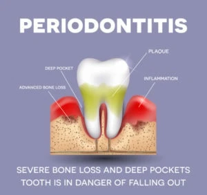 dental laser periodontal therapy1